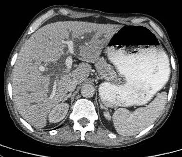 Figure 14: another case showing biliary dilatation and attenuation of right main portal vein. Patient had bulky nodes at porta causing biliary dilatation.